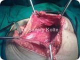 open repair incisional herniat